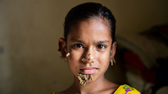 Ni&ntilde;a banglades&iacute; podr&iacute;a ser la primera mujer en sufrir el s&iacute;ndrome del 