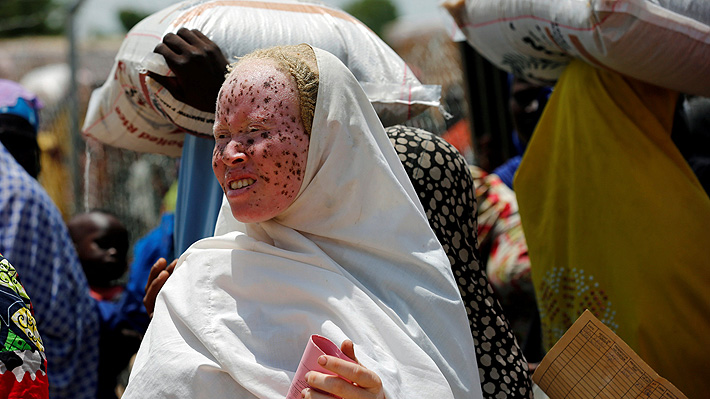 Terror en &Aacute;frica: Denuncian una nueva ola de ataques a albinos en Malaui