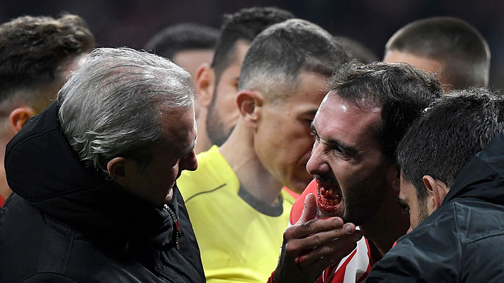 Atlético Madrid dio a conocer el estado de Godín luego del brutal golpe que lo hizo perder tres dientes