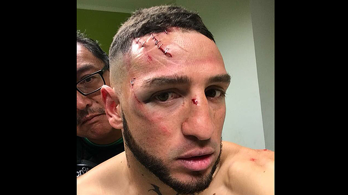 Los impactantes cortes con los que terminó el portero de Wanderers tras recibir una brutal patada en el rostro