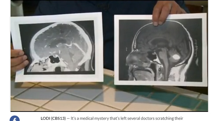 EE.UU.: Médicos sorprendidos por tumor que desapareció sin explicación del cerebro de un paciente