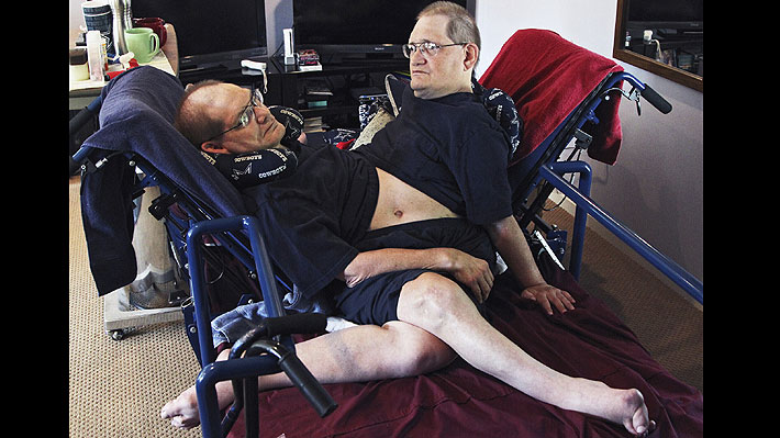 Ronnie y Donnie, los siameses más longevos del mundo, murieron a los 68 años