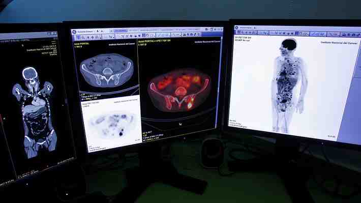 Cáncer en Chile: La importancia de una detección temprana, prevención y nuevos tratamientos