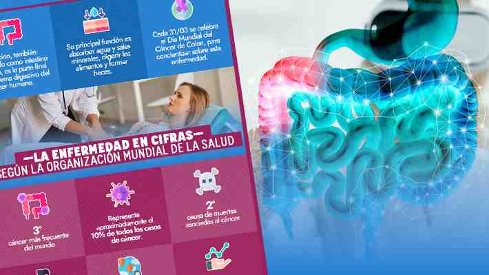 Las claves para detectar y combatir al cáncer de colon: Nueve personas mueren al día por esta causa en Chile