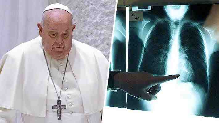 Neumonía bilateral, el "complejo" cuadro por el que atraviesa el papa en el que las próximas horas son claves