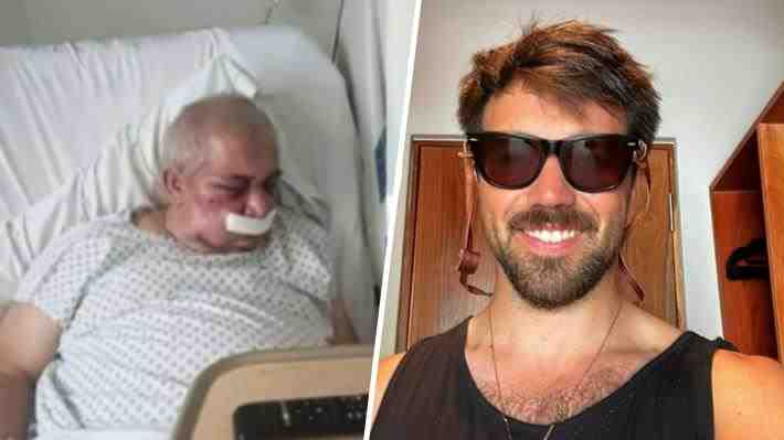 Brutal golpiza a conserje de 70 años en Vitacura: Quedó con múltiples fracturas y podría perder visión de un ojo