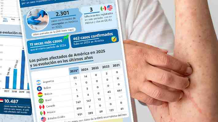 Vacunación contra el sarampión: ¿Cómo han evolucionado los casos en América y el mundo?