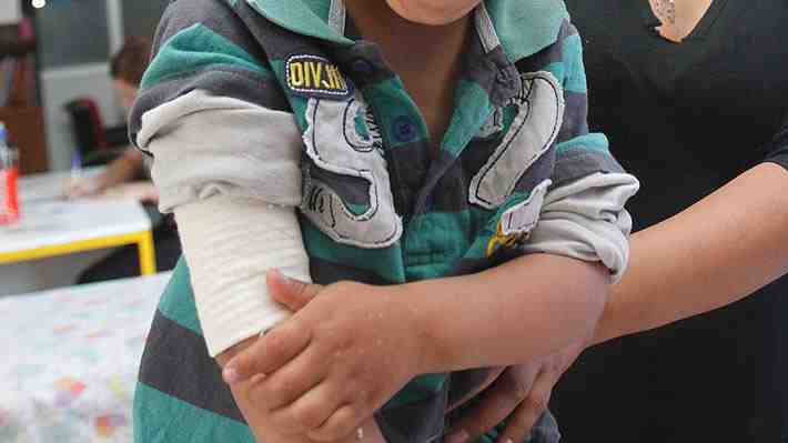 Estudio chileno revela que 1 de cada 5 niños que sufren quemaduras necesitará rehabilitación por secuelas cicatriciales
