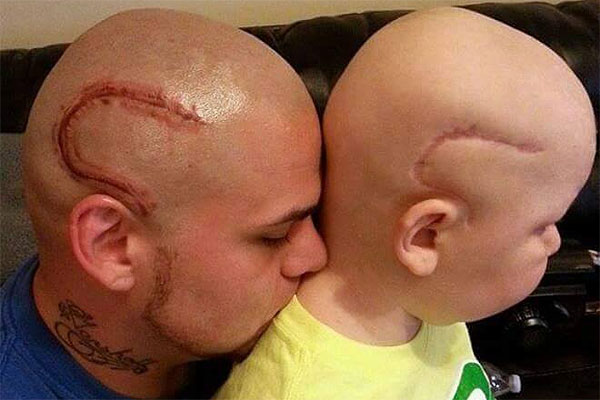 Tierno gesto de un padre con su hijo: imitó la cicatriz que le dejó un cáncer para mejorarle la autoestima
