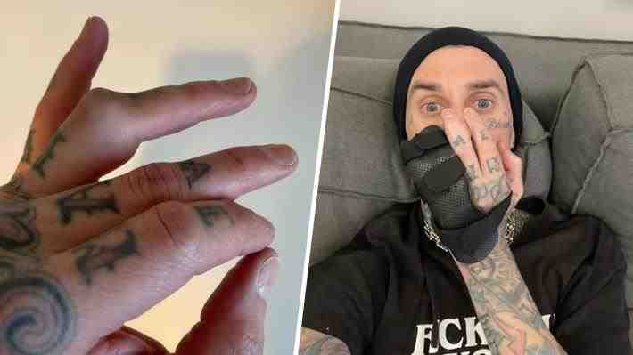 A pocas semanas de su presentación en Lollapalooza Chile, baterista de Blink-182 sufre aparatosa lesión en su dedo